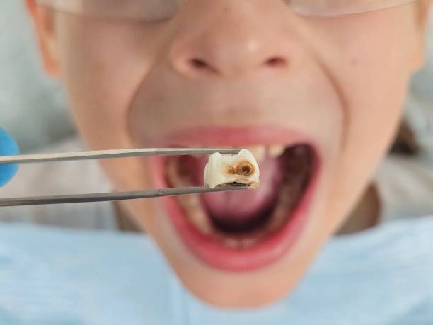 Best Emergency Root Canal Treatment in Merrill, WI